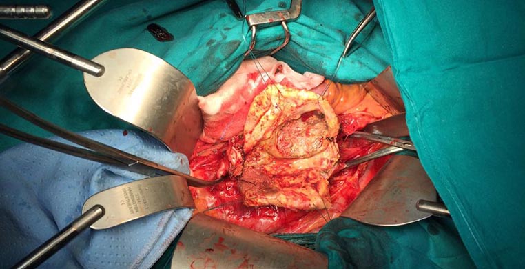 operazioni cardiochirurgia palermo