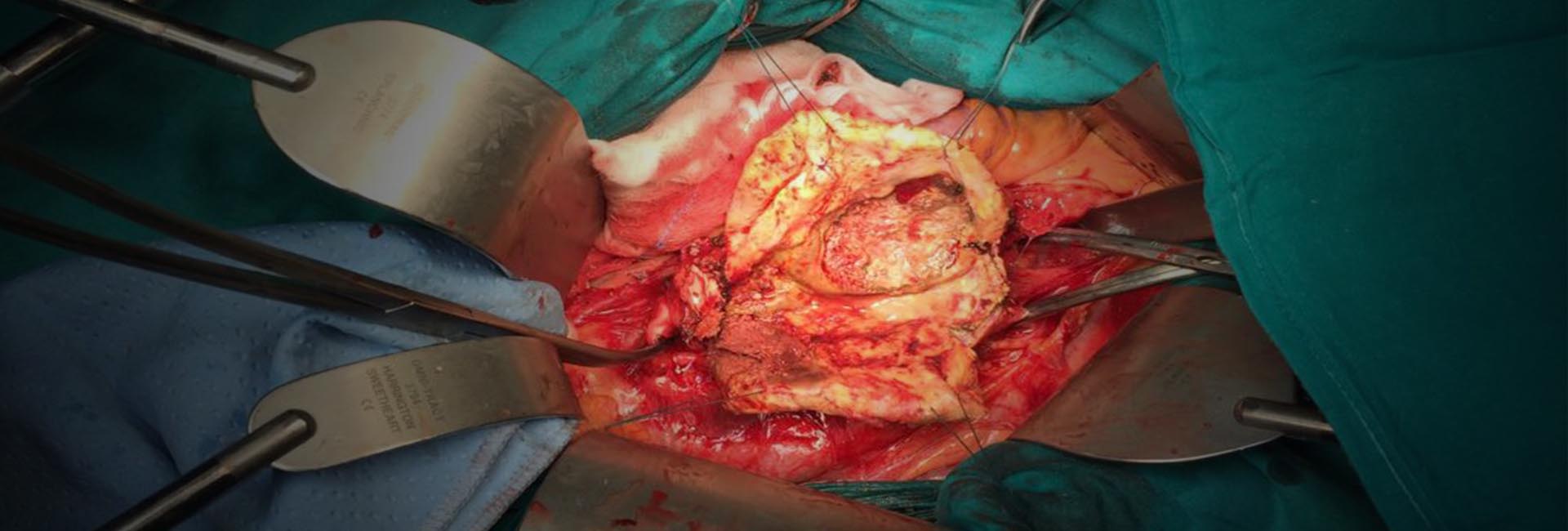 operaztion aorta from doctor Emerico Ballo Cardio surgeon