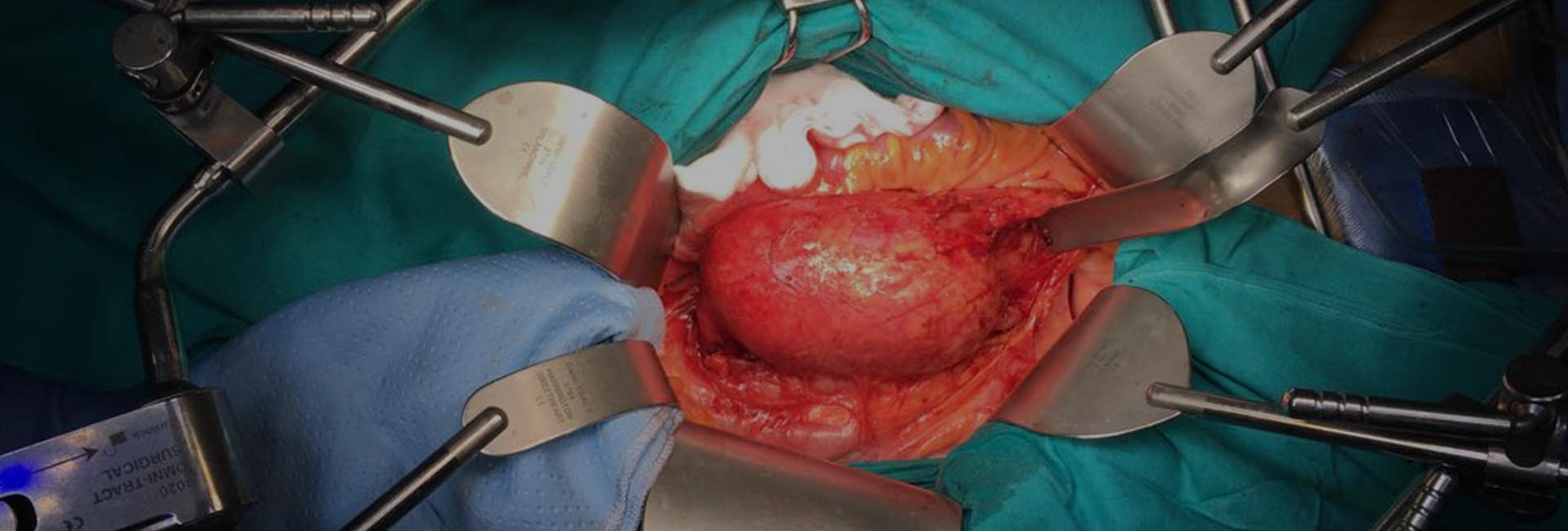 operazione di cardio chirurgia del dottor emerico ballo medico cardio chirurgo palermo